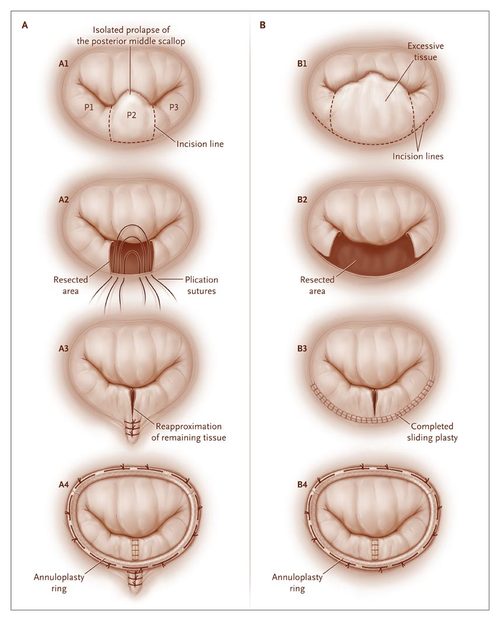 Minimally Invasive Mitral Valve Repair Dr. Ciuffo