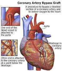 minimally invasive heart valve surgery 