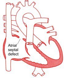 hole in the heart - atrial septal defect