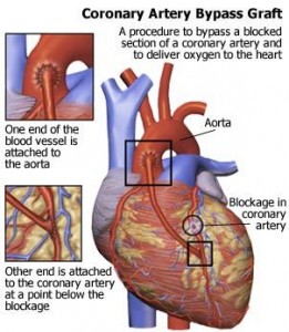 minimally invasive heart bypass graph