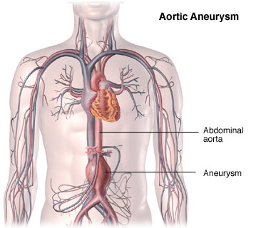 inoperable aortic aneurysm diagram