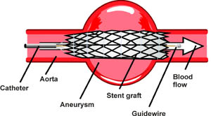 A stent is inserted through the aneurysm to repair it from the inside instead of replacing the aorta itself