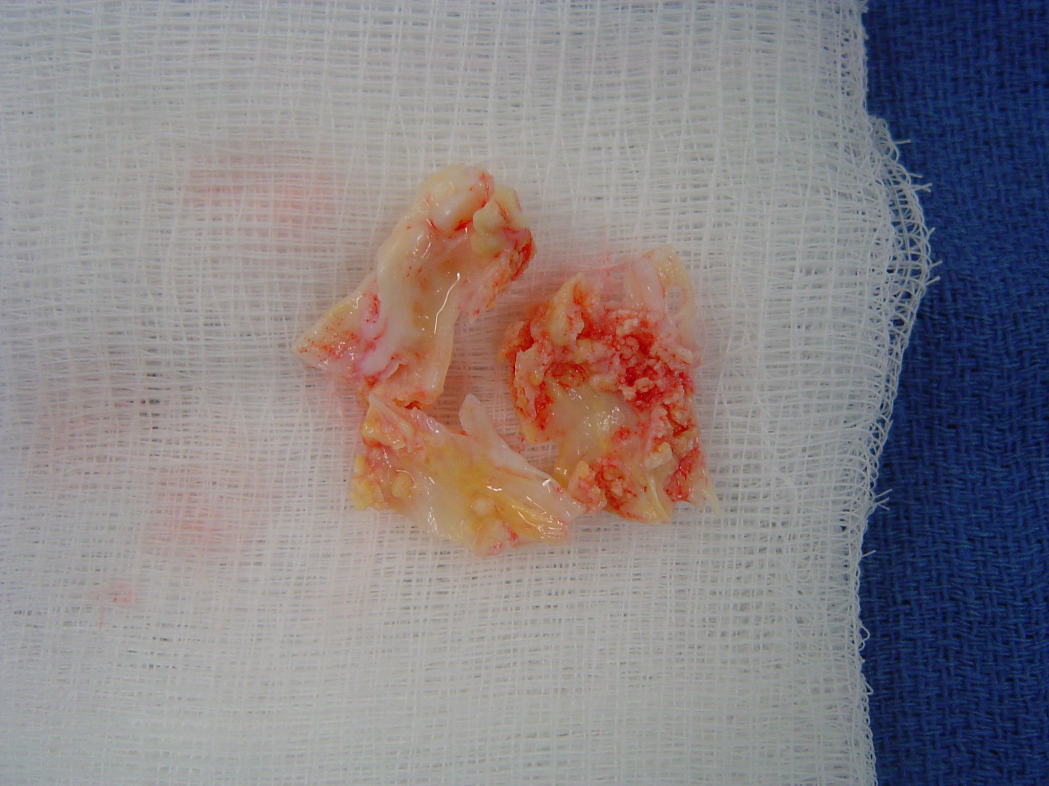 Aortic valve calcification, operative specimen