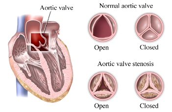narrow opening diagram in aortic valve stenosis