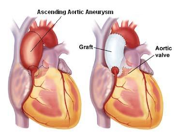 The ascending aortic aneurysm is best repaired by replacing the ballooned out aortic segment with a tubular graft