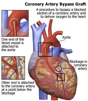 minimally invasive coronary artery bypass surgery diagram