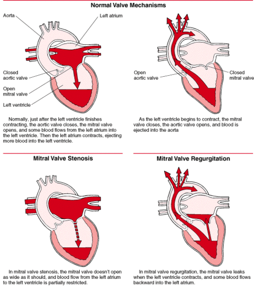 mitral valve stenosis