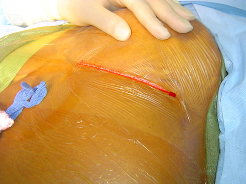 Minimally Invasive Coronary Artery Bypass surgery picture MIDCAB