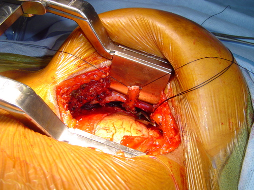minimally invasive coronary artery bypass surgery left internal mammary