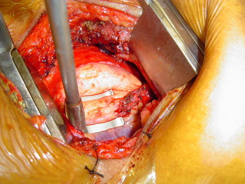 minimally invasive coronary artery bypass surgery