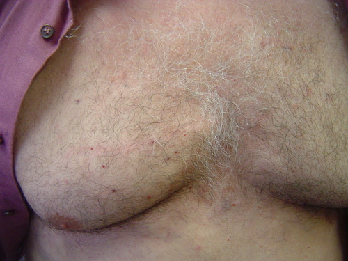 scar after minimally invasive cardiac surgery