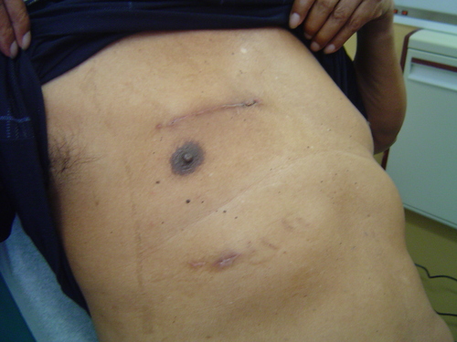 minimally invasive heart surgery scar