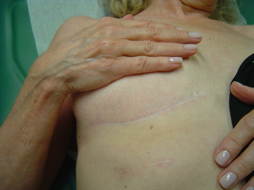 minimally invasive heart surgery scar female 2