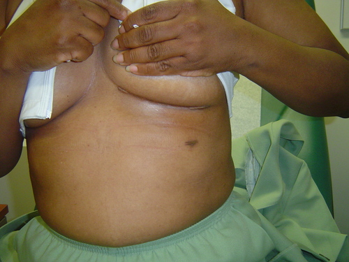 minimally invasive heart surgery scar female