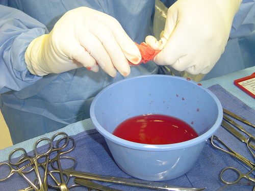 bloodless heart surgery blood saving bowl