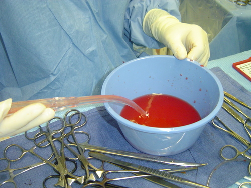 blood cells suctioned into cell saver machine