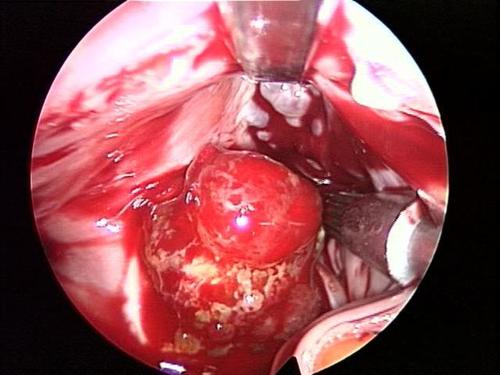 minimally invasive atrial myxoma surgery picture