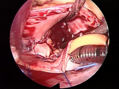 after minimally invasive atrial myxoma surgery picture