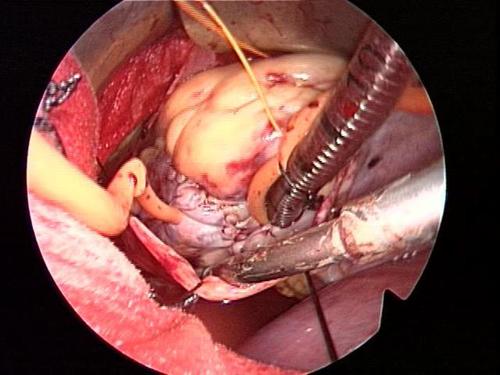 minimally invasive atrial myxoma surgical picture