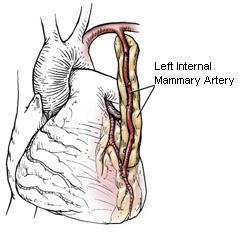 minimally invasive coronary artery bypass surgery mammarysm