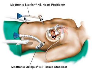 minimally invasive coronary artery bypass surgery diagram