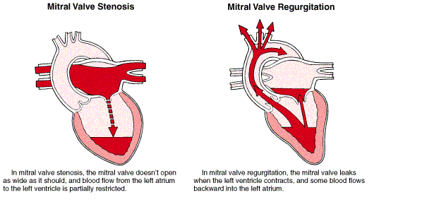 Mechanism of Mitral Stenosis and Mitral Regurgitation