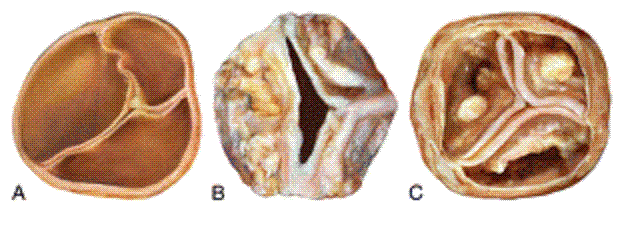 bicuspid aortic stenosis