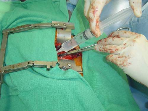 Intercostal nerve block anesthesia in minimally invasive heart surgery