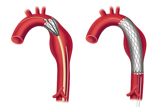 A Stent is deployed to repair a Thoracic Aortic Aneurysm