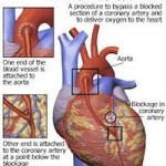 Coronary Artery Bypass Grafting