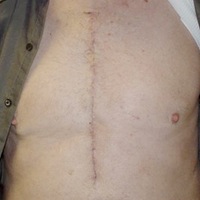 open heart surgery scar