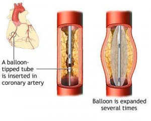 balloon angioplasty diagram