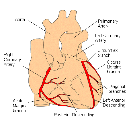 coronary angioplasty diagram
