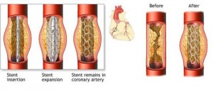 coronary artery stents diagram