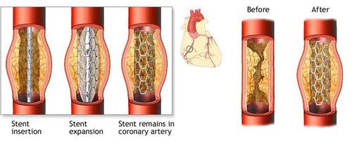 coronary-angioplasty-with-hybrid-valves-heart-surgery-information