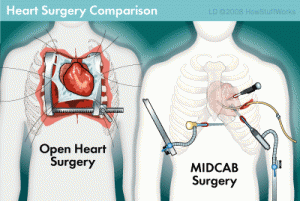 open heart surgery