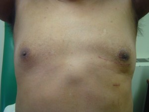minimally invasive heart surgery scar