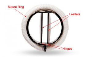 mechanical heart valve replacement