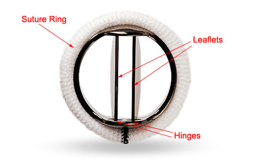 mechanical heart valve replacement