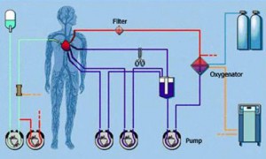 heart lung machine diagram