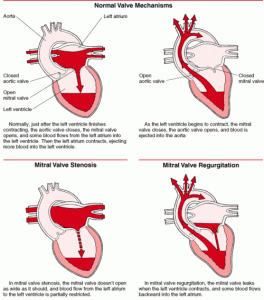 Mitral Valve Chordae Repair