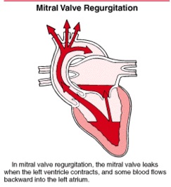 mitral valve regurgitation diagram
