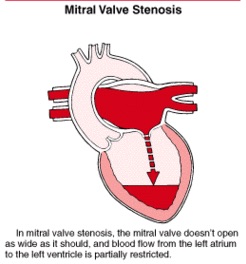 mitral valve stenosis diagram