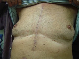 sternotomy scar