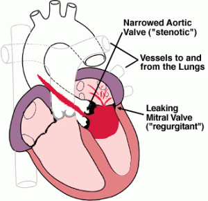 Peripheral Vascular Disease