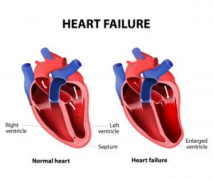 Heart Failure Prevention