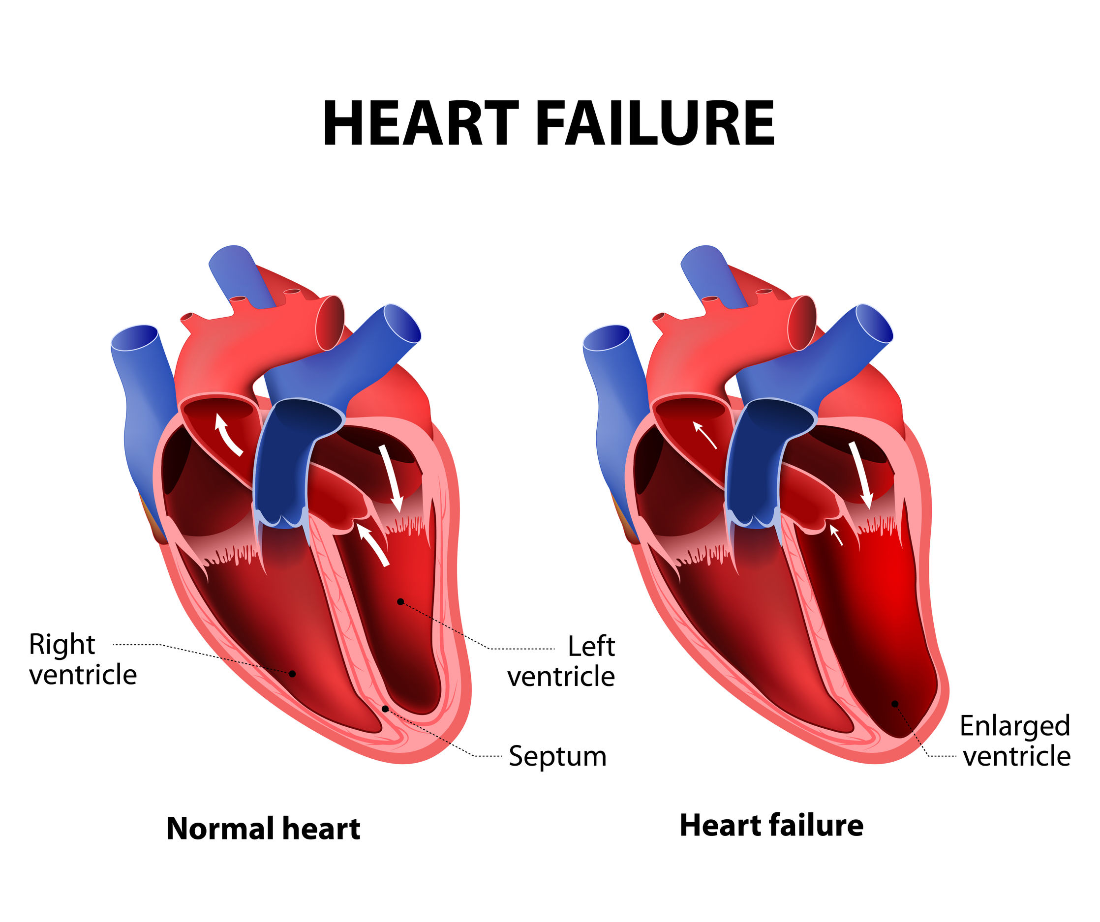 Сколько весит искусственный левый желудочек для сердца. Сердечная недостаточность. Левый желудочек. Левый желудочек сердца. Здоровое и больное сердце.